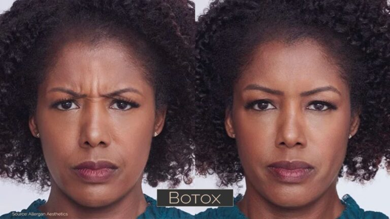 Botox