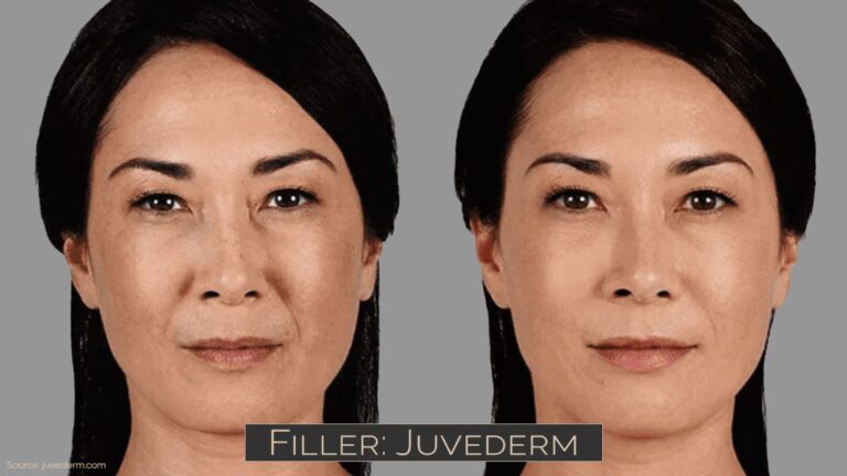 Filler Juvederm