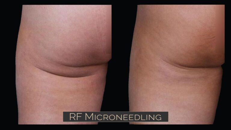 RF Microneedling